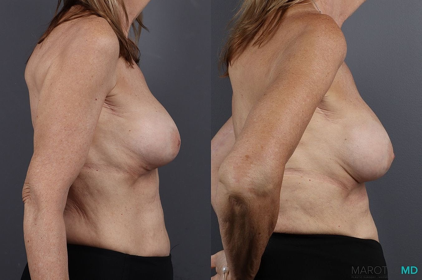 Implant Exchange Before & After