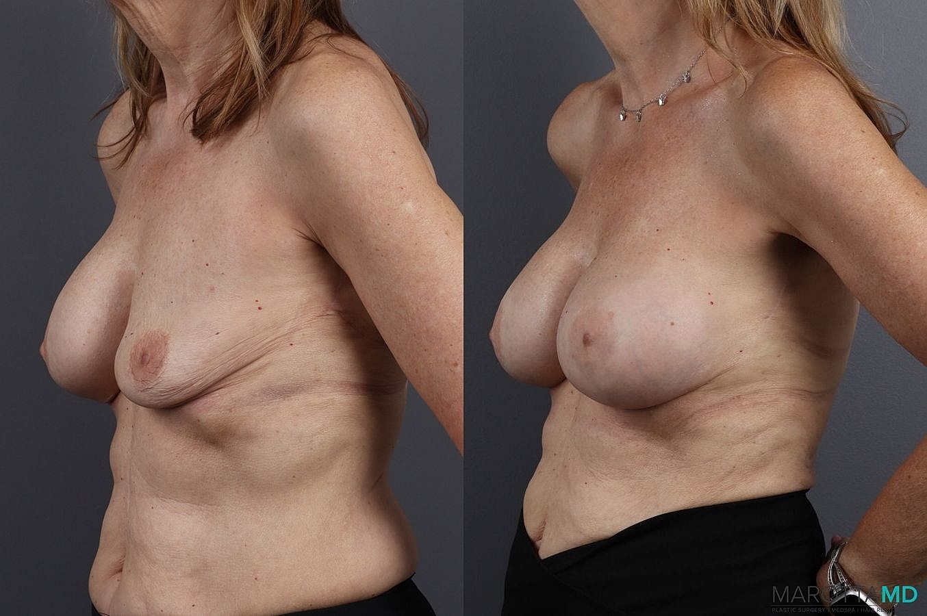 Implant Exchange Before & After
