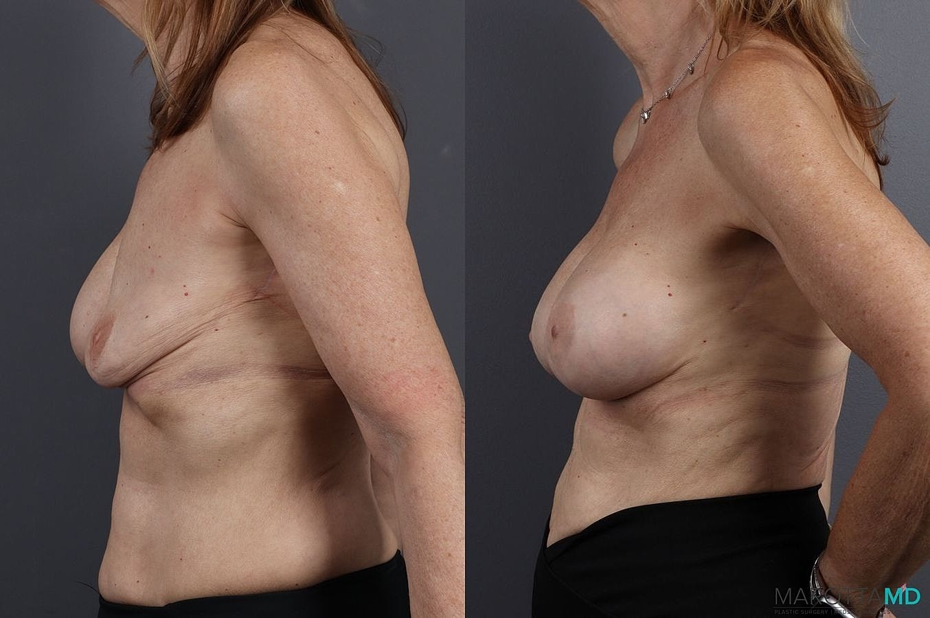 Implant Exchange Before & After