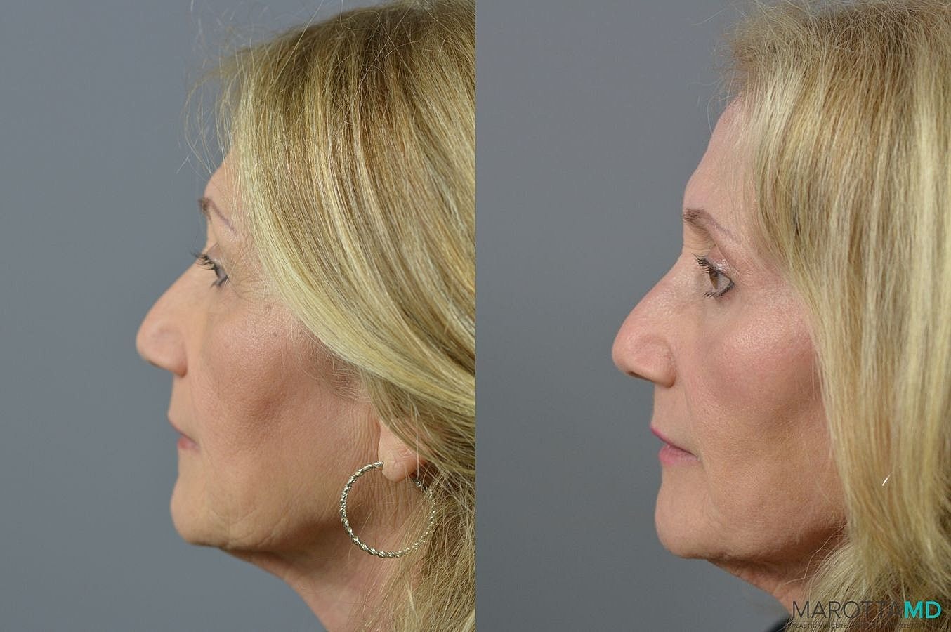Eyelid Surgery Before & After