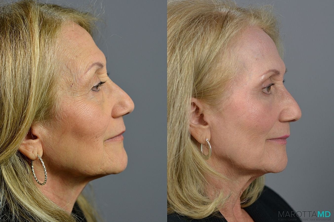 Eyelid Surgery Before & After