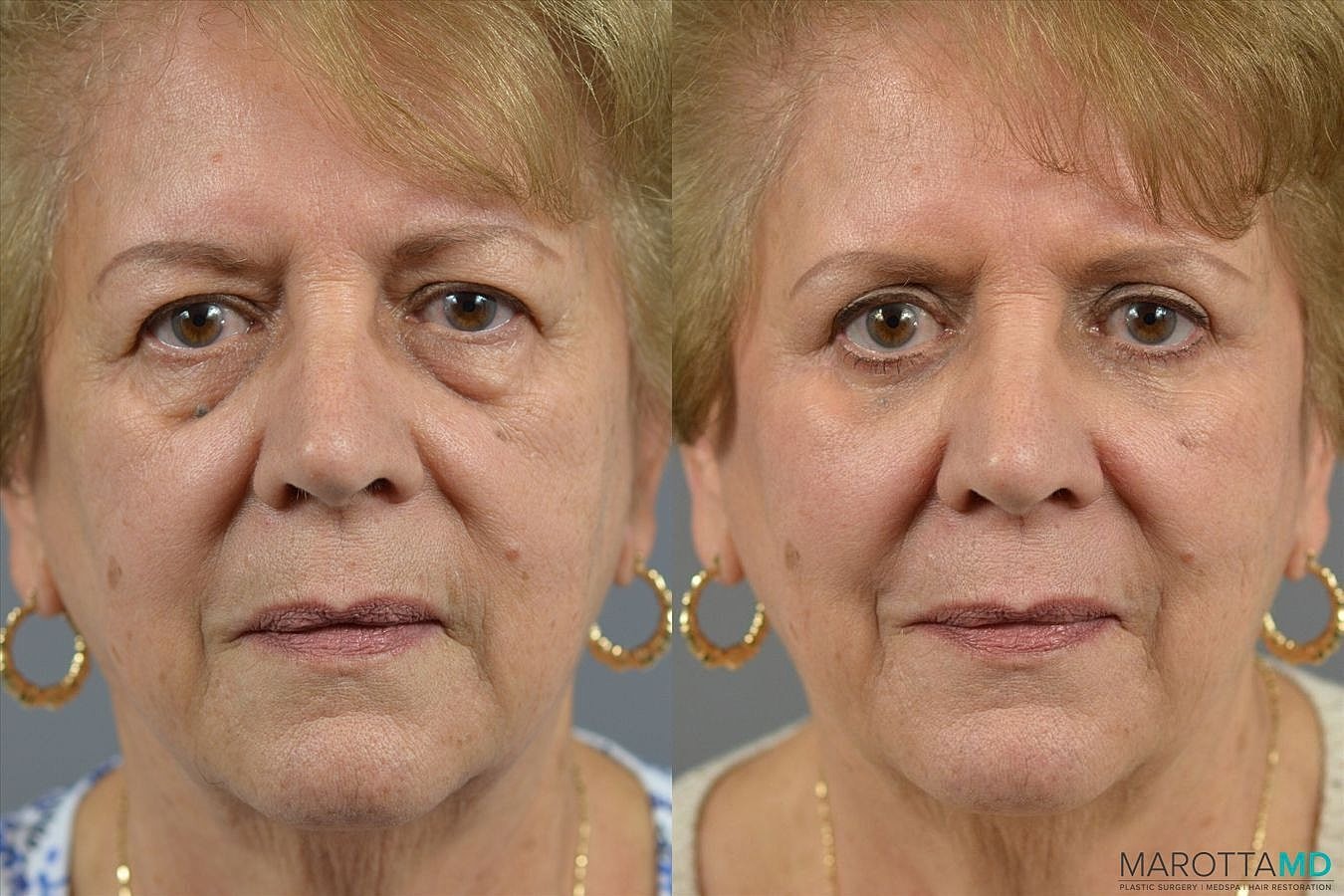 Eyelid Surgery Before & After