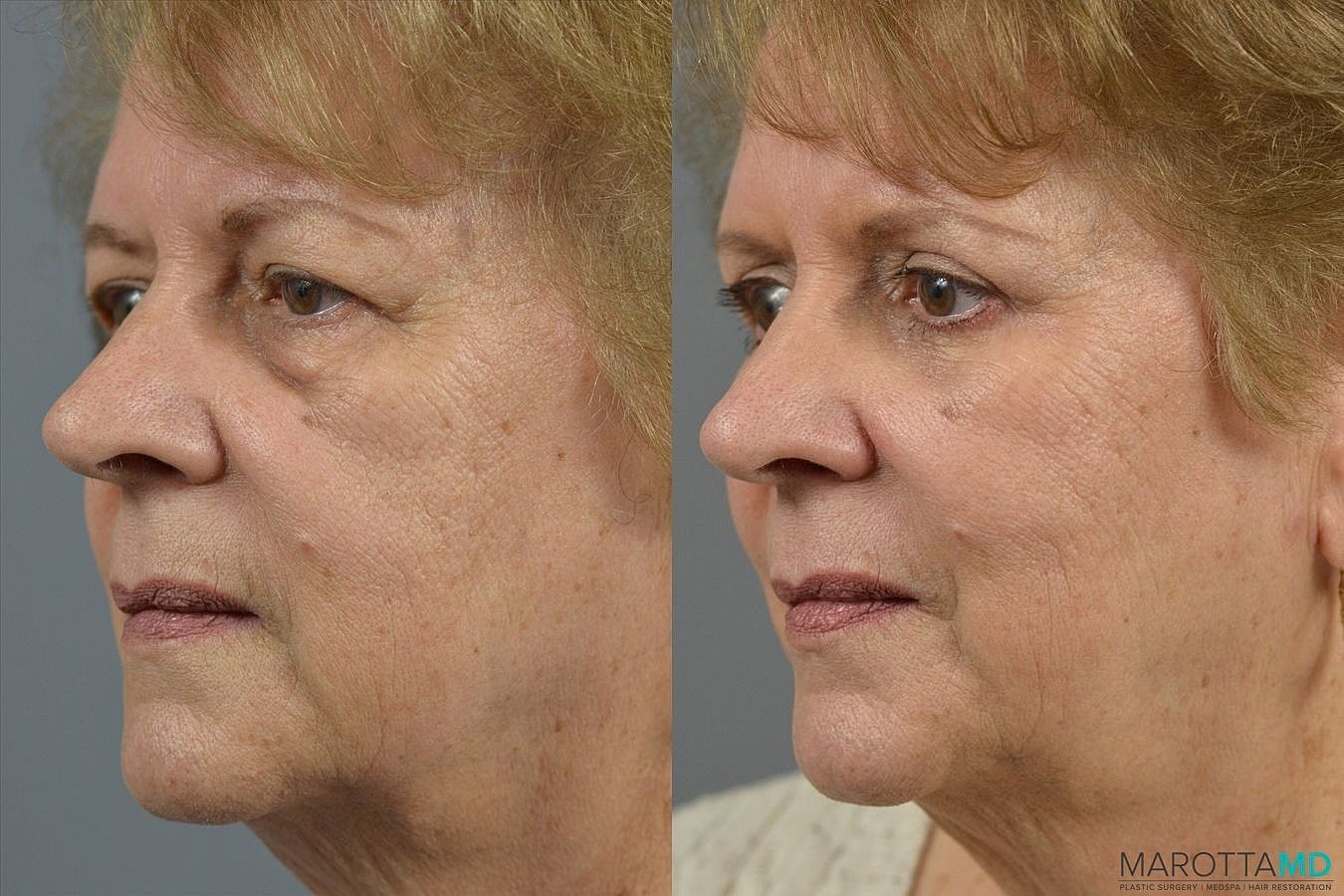 Eyelid Surgery Before & After