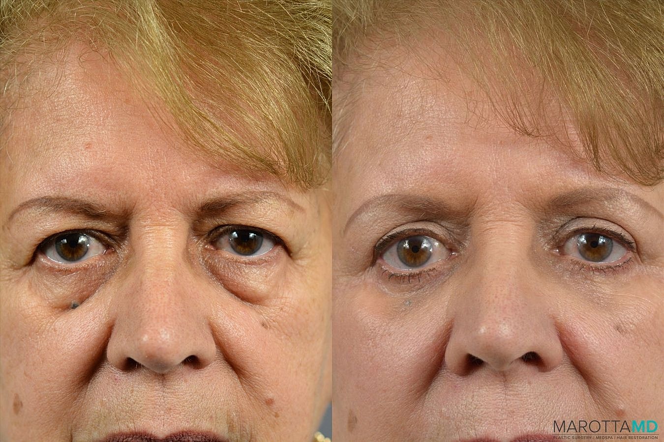 Eyelid Surgery Before & After