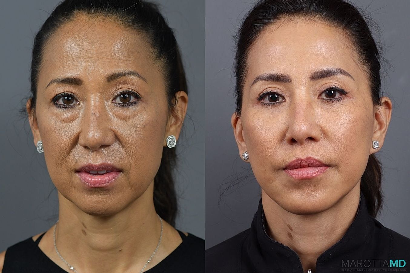 Eyelid Surgery Before & After