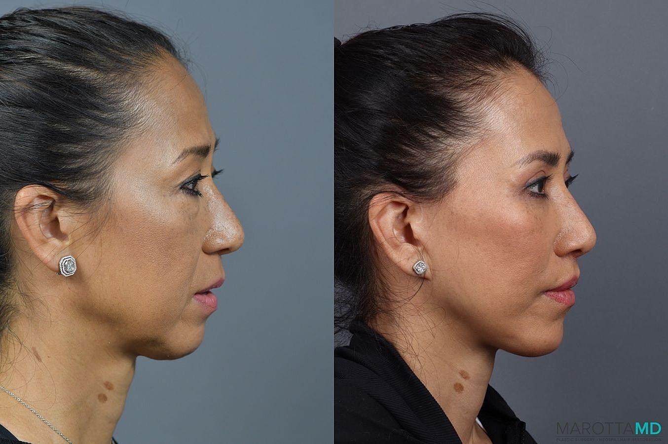 Eyelid Surgery Before & After