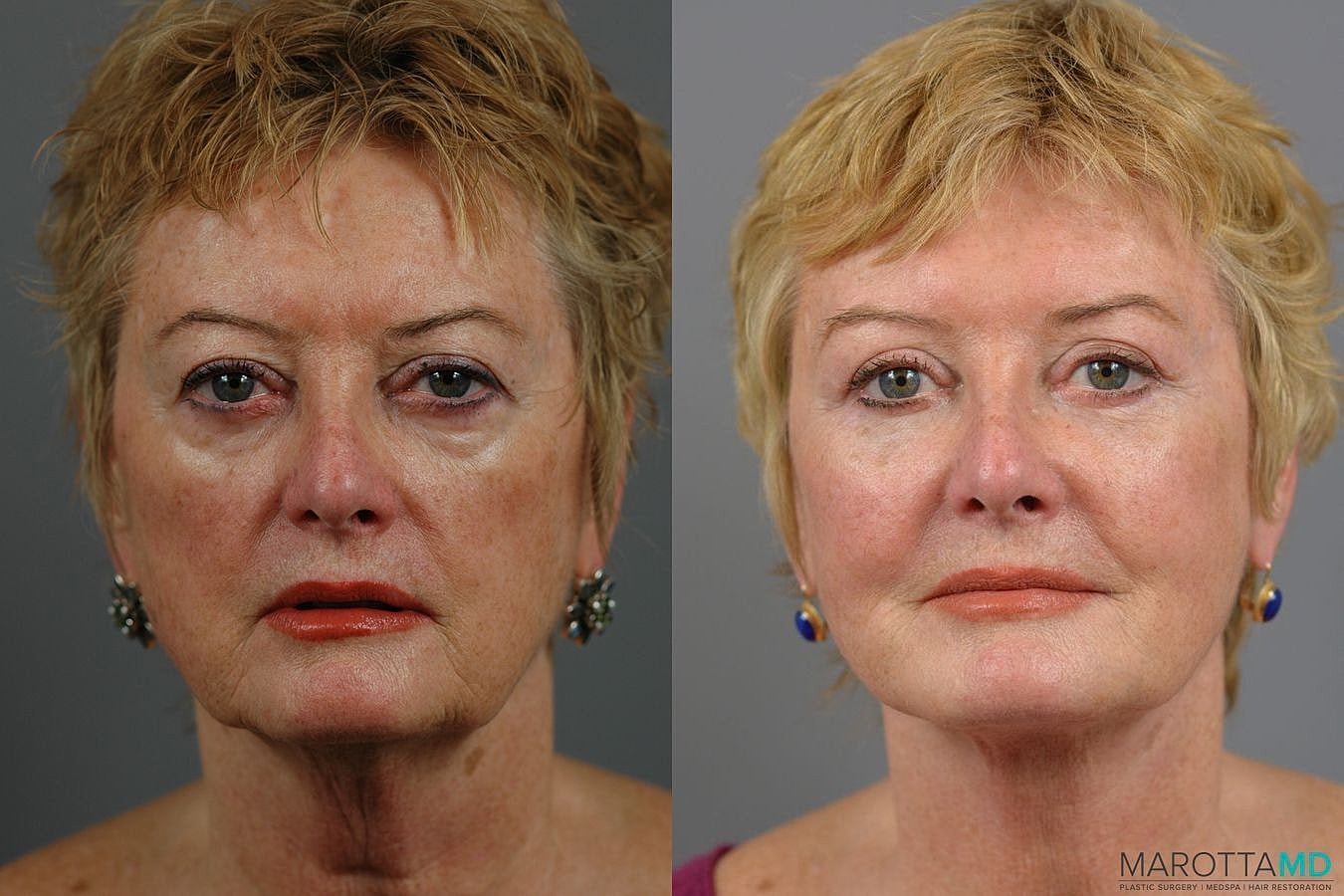 Eyelid Surgery Before & After