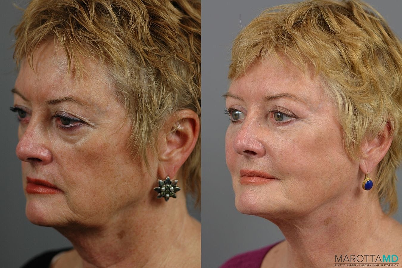 Eyelid Surgery Before & After