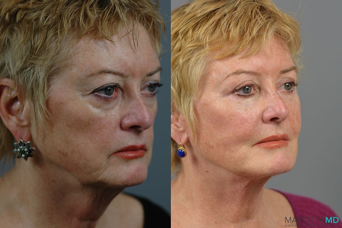 Eyelid Surgery Before & After