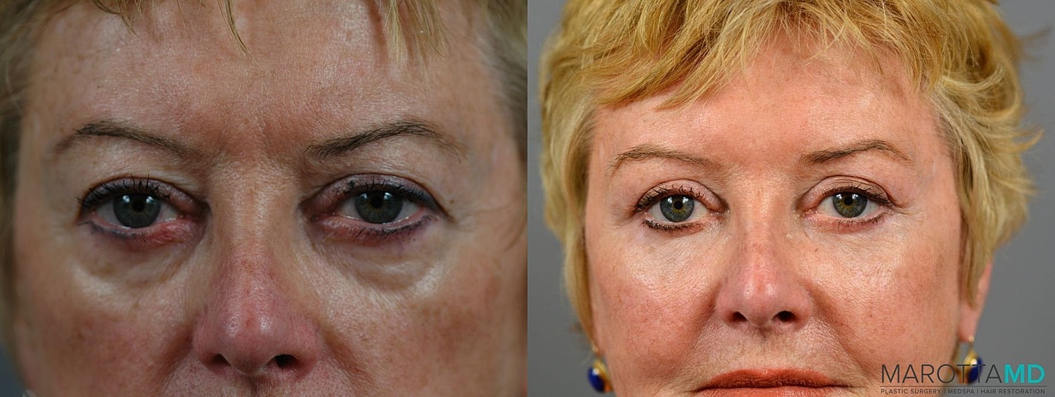 Eyelid Surgery Before & After