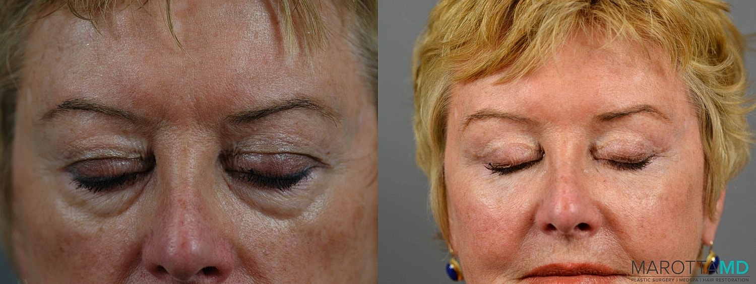 Eyelid Surgery Before & After