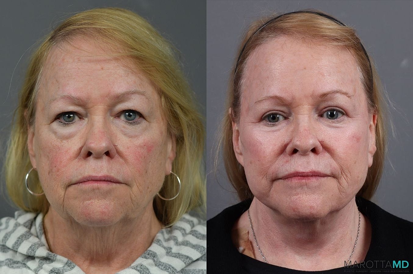 Eyelid Surgery Before & After