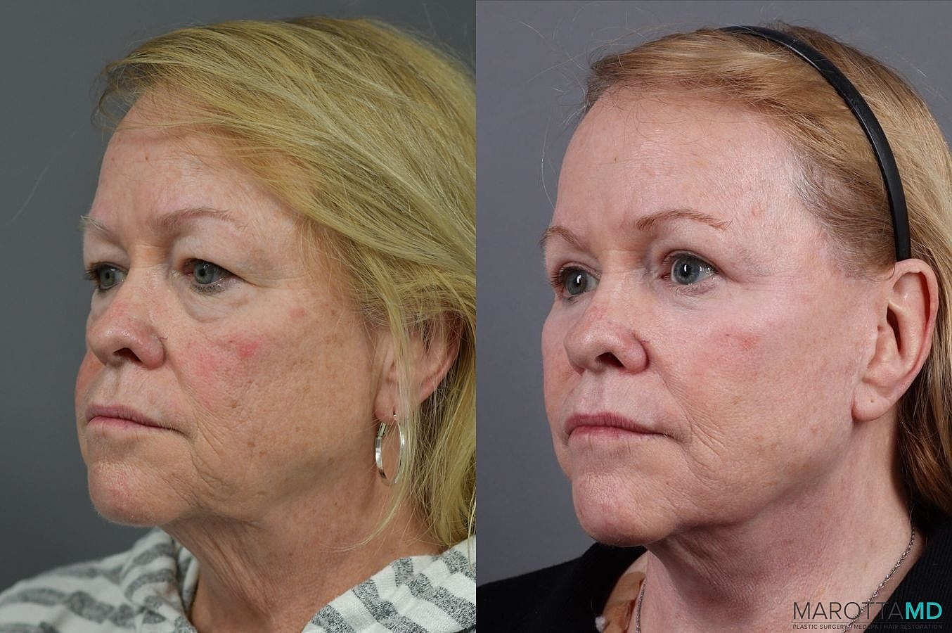 Eyelid Surgery Before & After