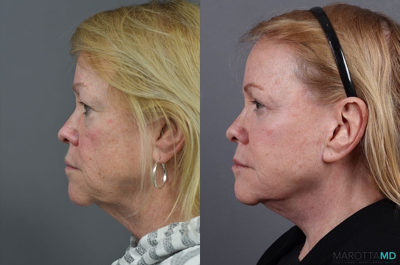 Eyelid Surgery Before & After