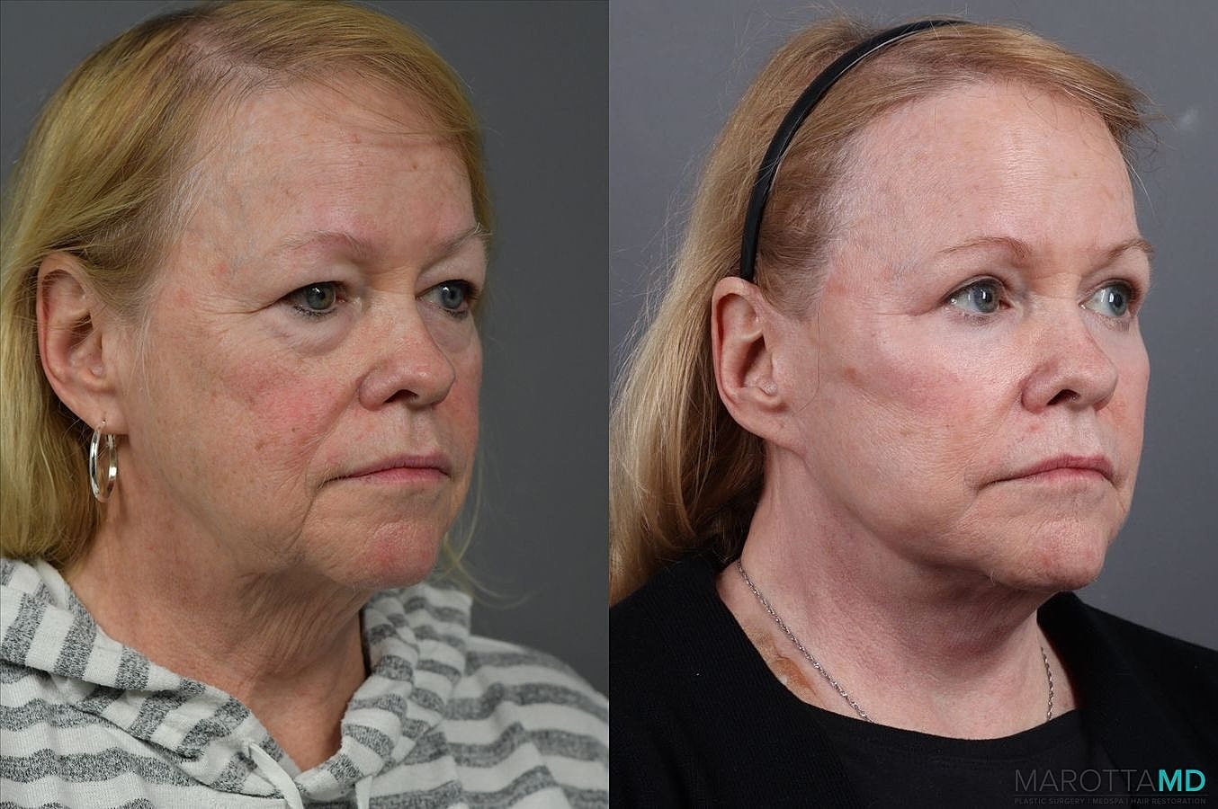 Eyelid Surgery Before & After