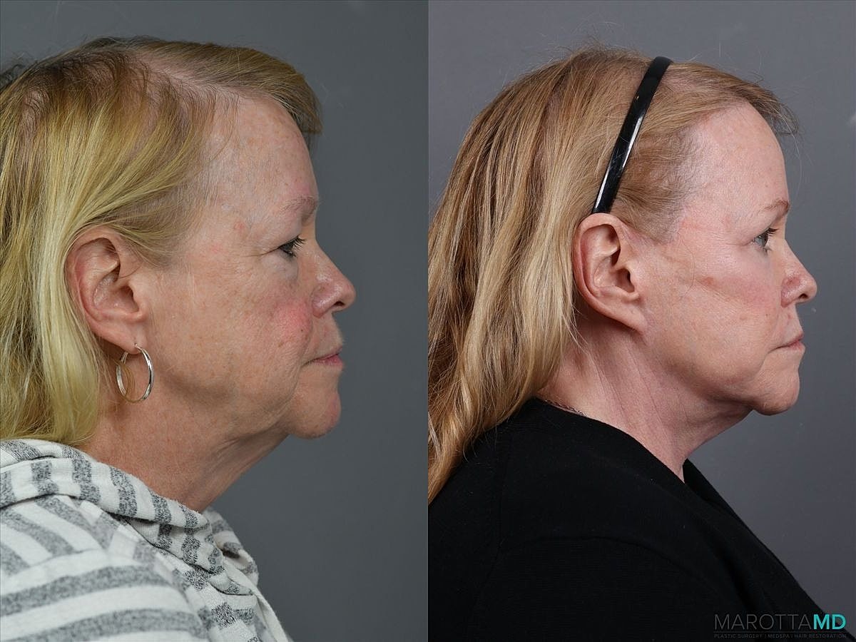 Eyelid Surgery Before & After