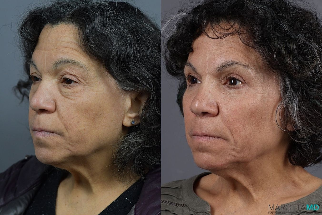 Eyelid Surgery Before & After