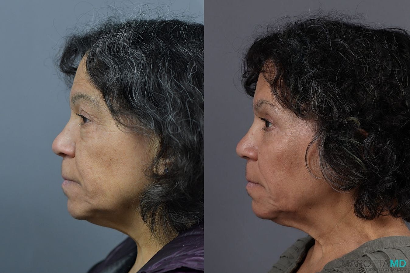 Eyelid Surgery Before & After