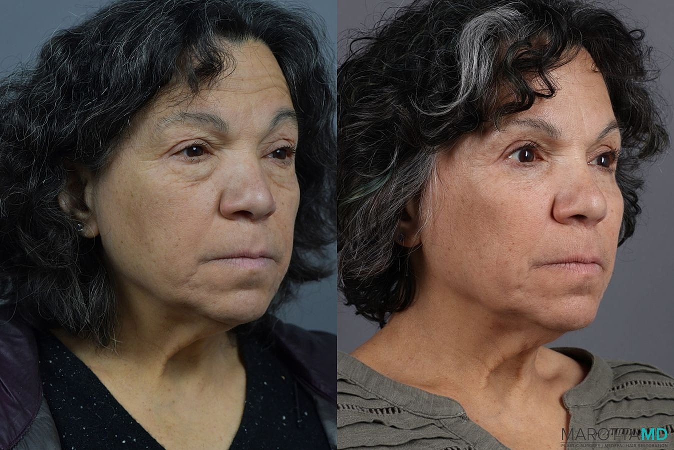 Eyelid Surgery Before & After