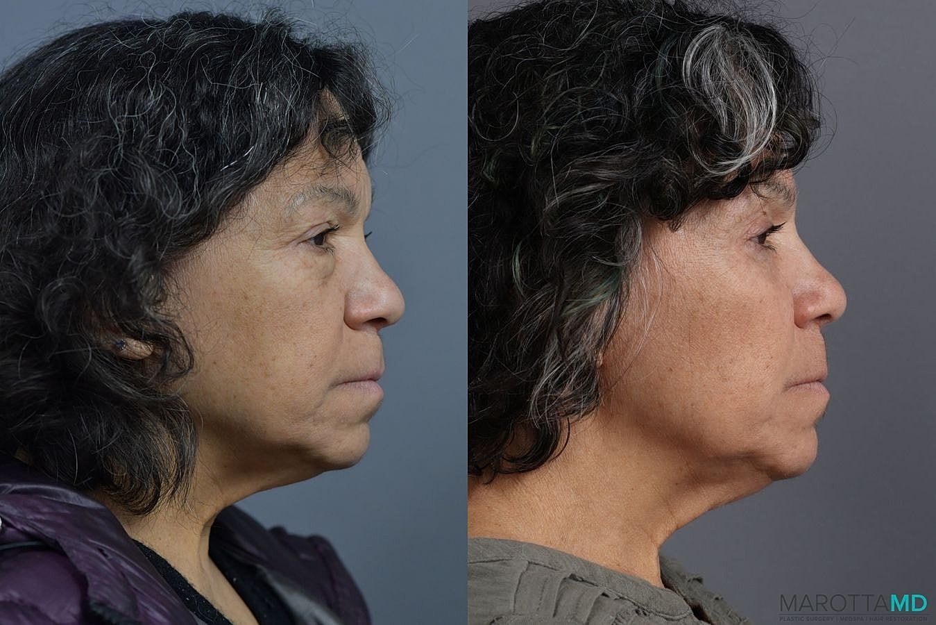 Eyelid Surgery Before & After