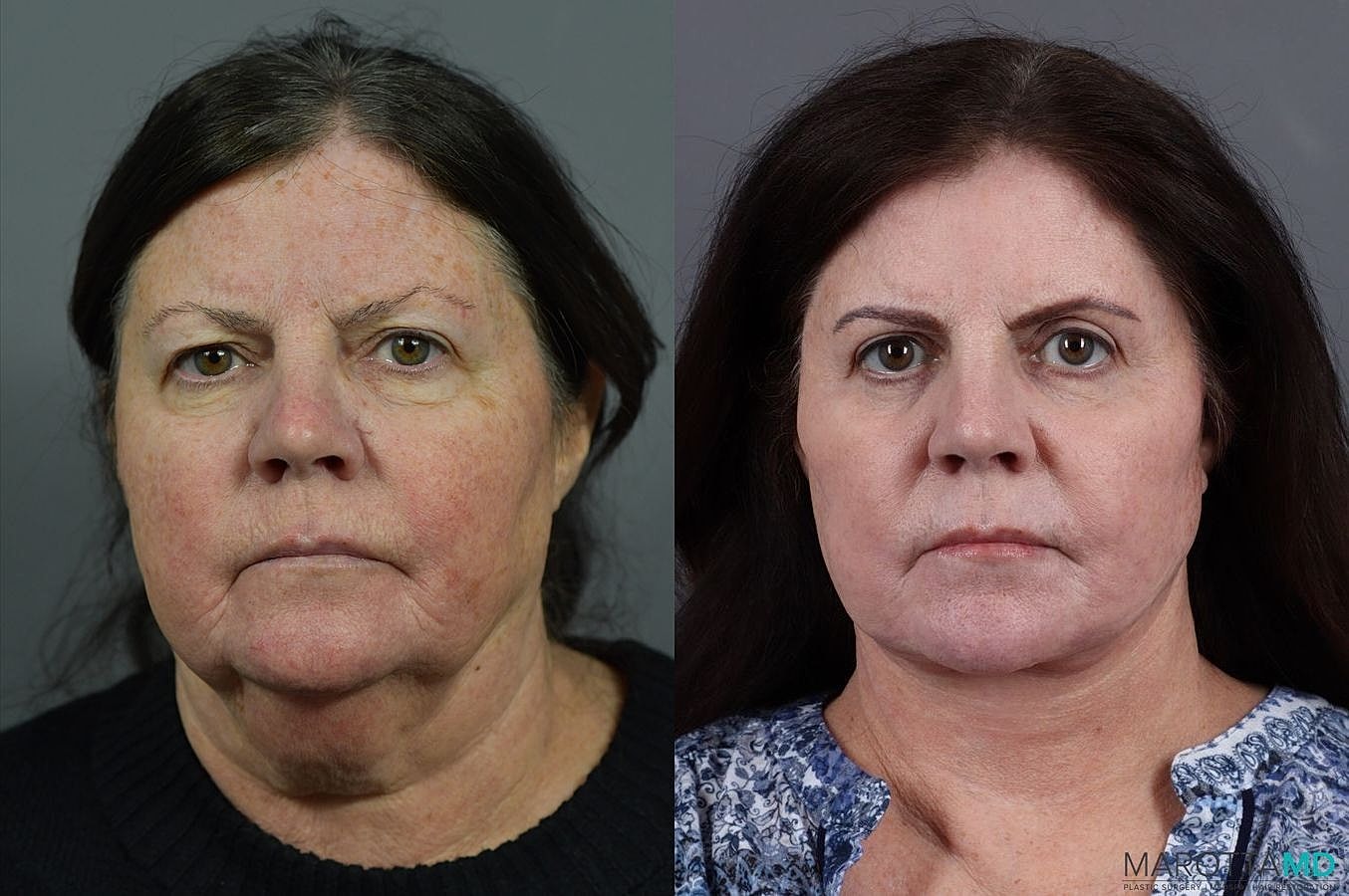 Eyelid Surgery Before & After