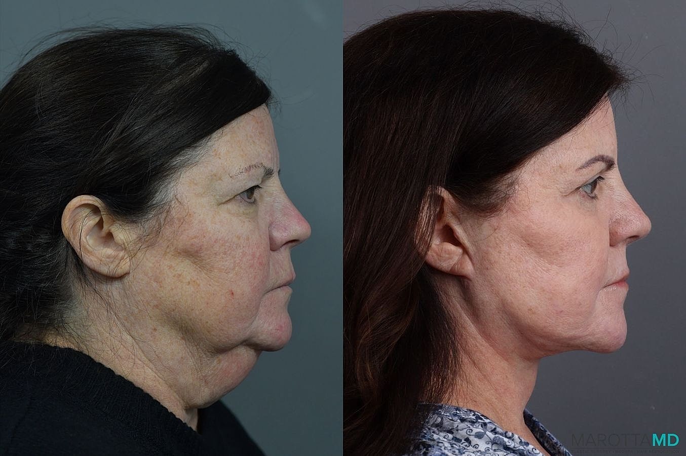 Eyelid Surgery Before & After