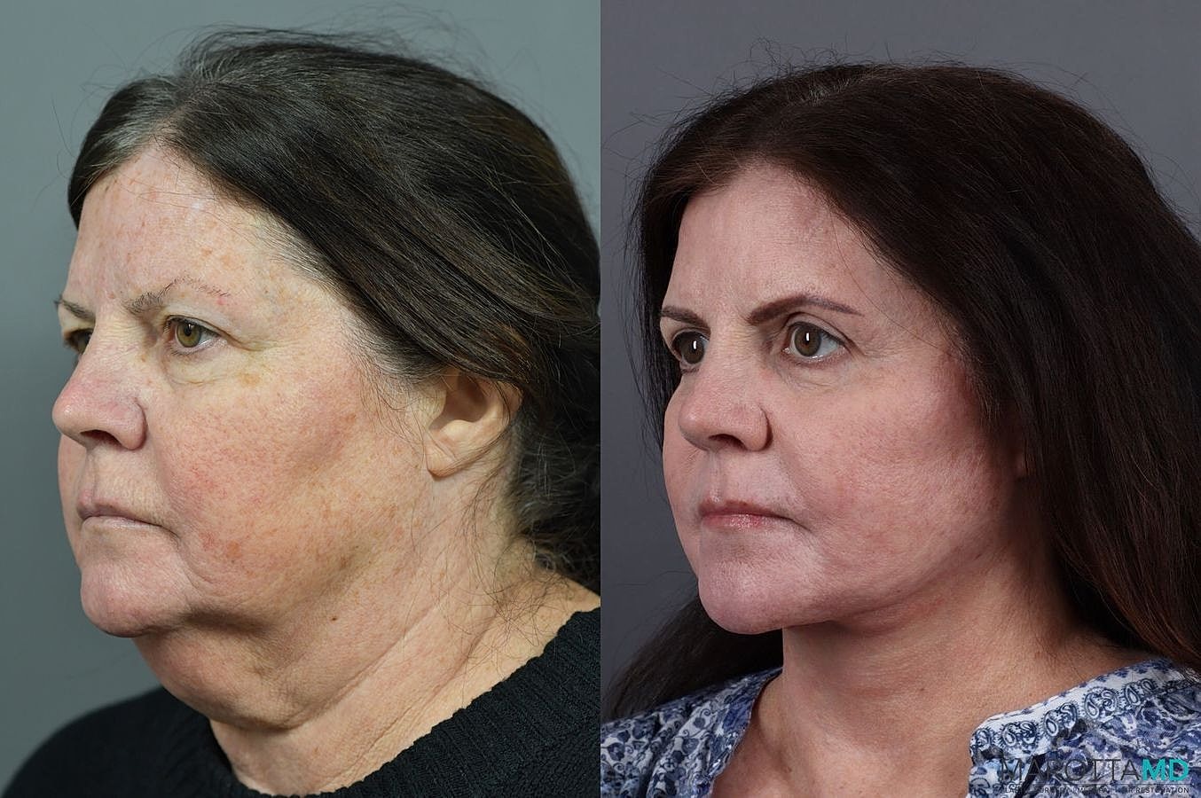 Eyelid Surgery Before & After