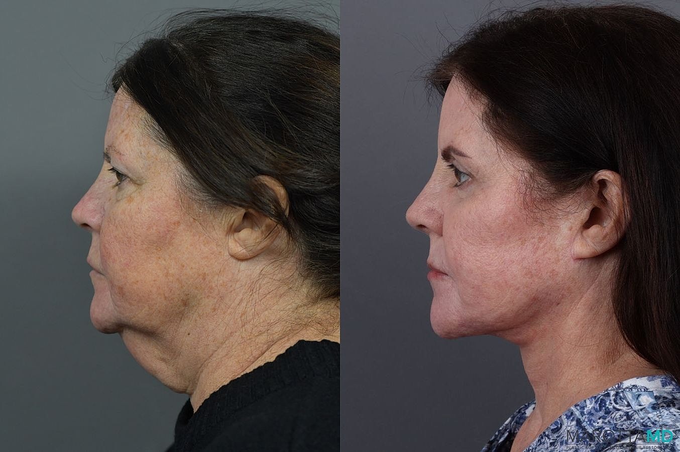 Eyelid Surgery Before & After