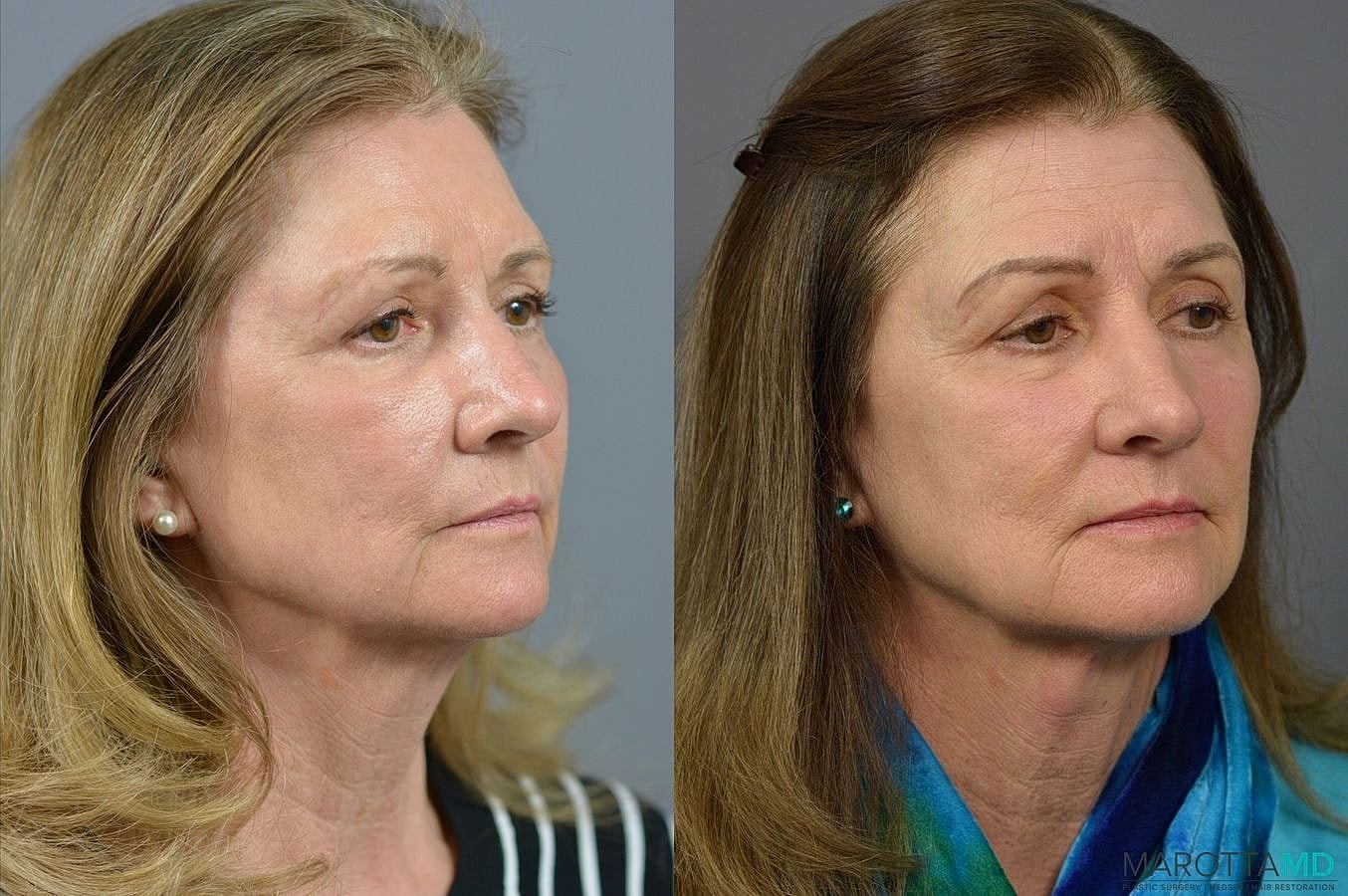 Eyelid Surgery Before & After