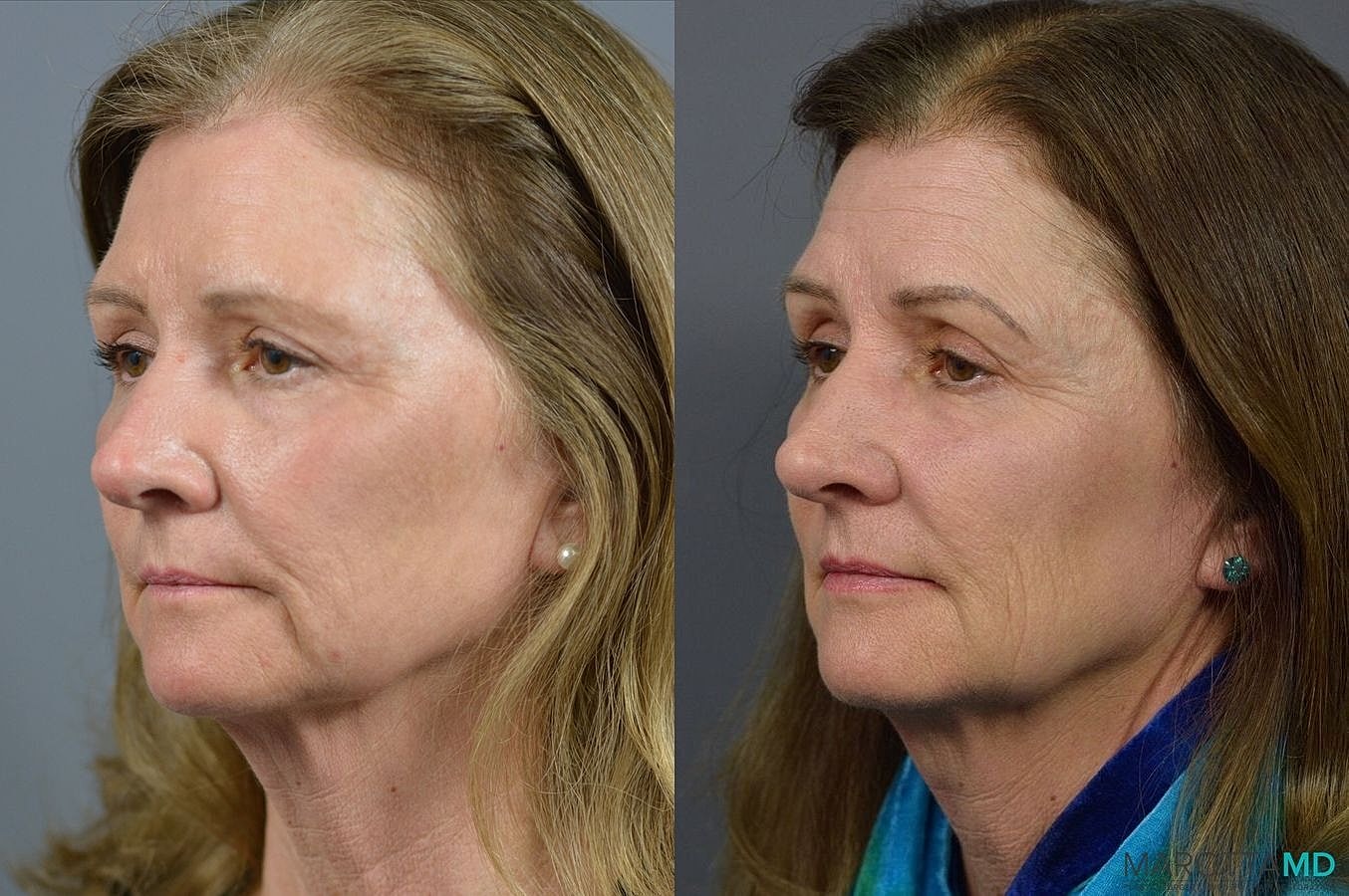 Eyelid Surgery Before & After