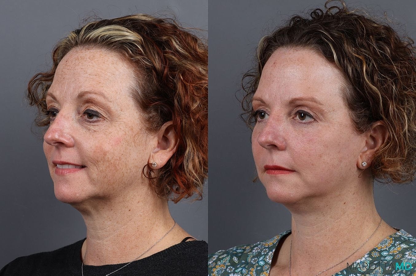 Eyelid Surgery Before & After