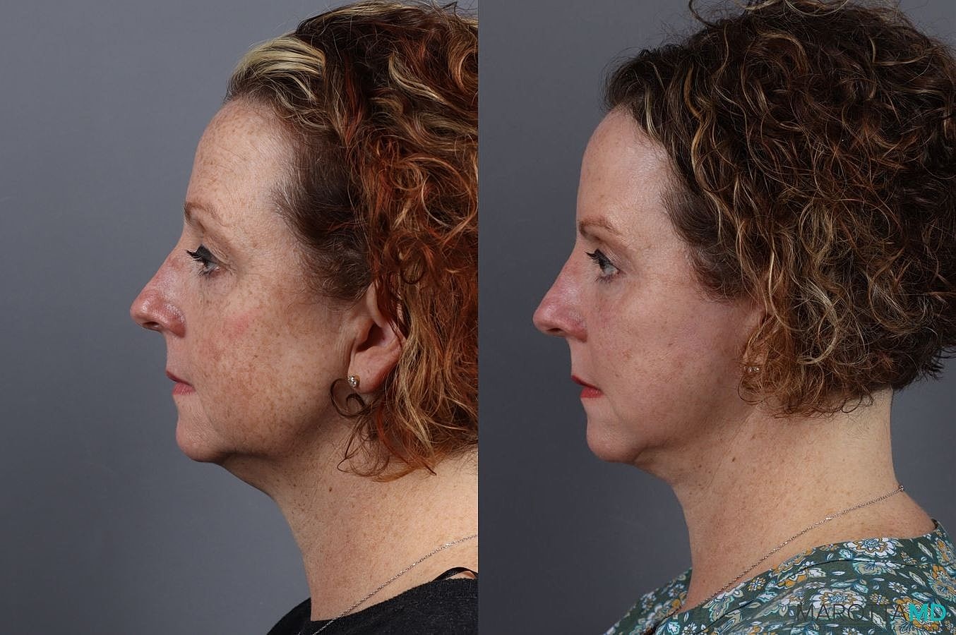 Eyelid Surgery Before & After