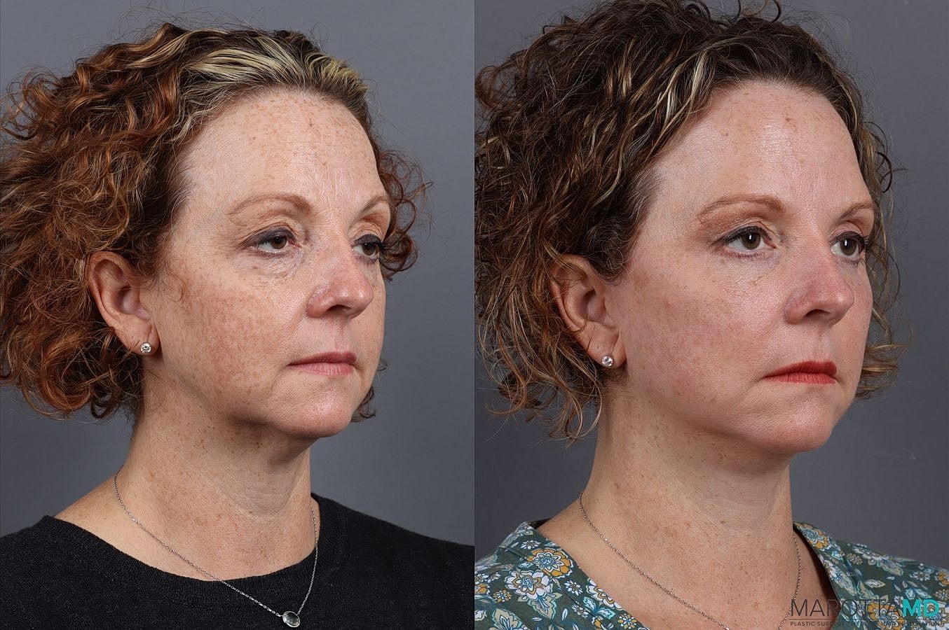 Eyelid Surgery Before & After