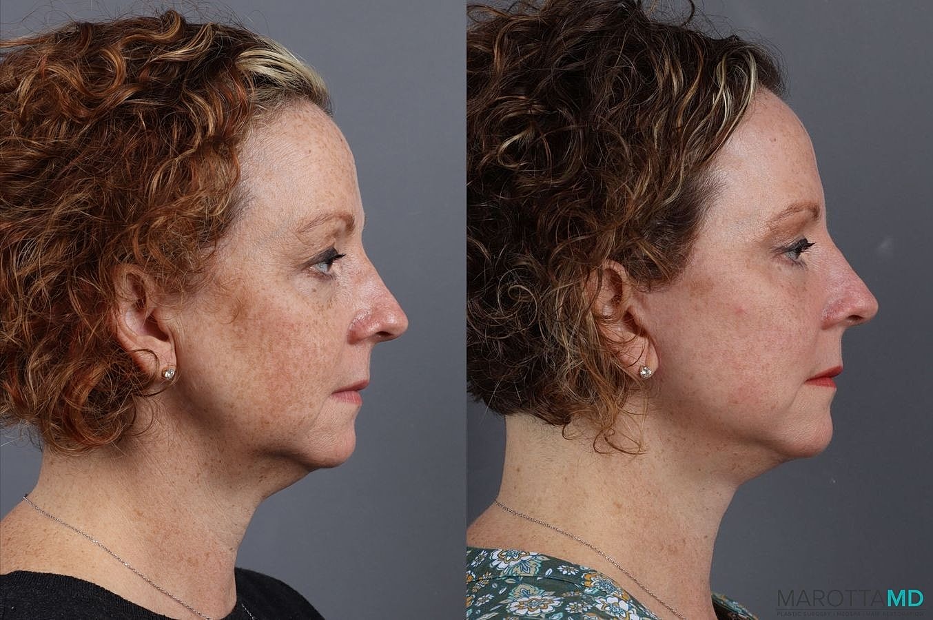 Eyelid Surgery Before & After