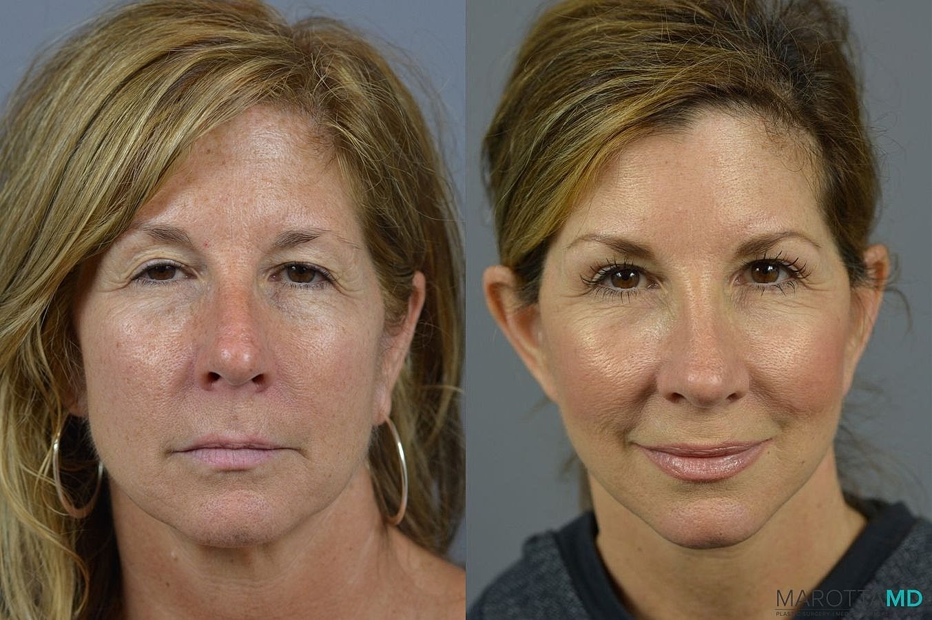 Eyelid Surgery Before & After