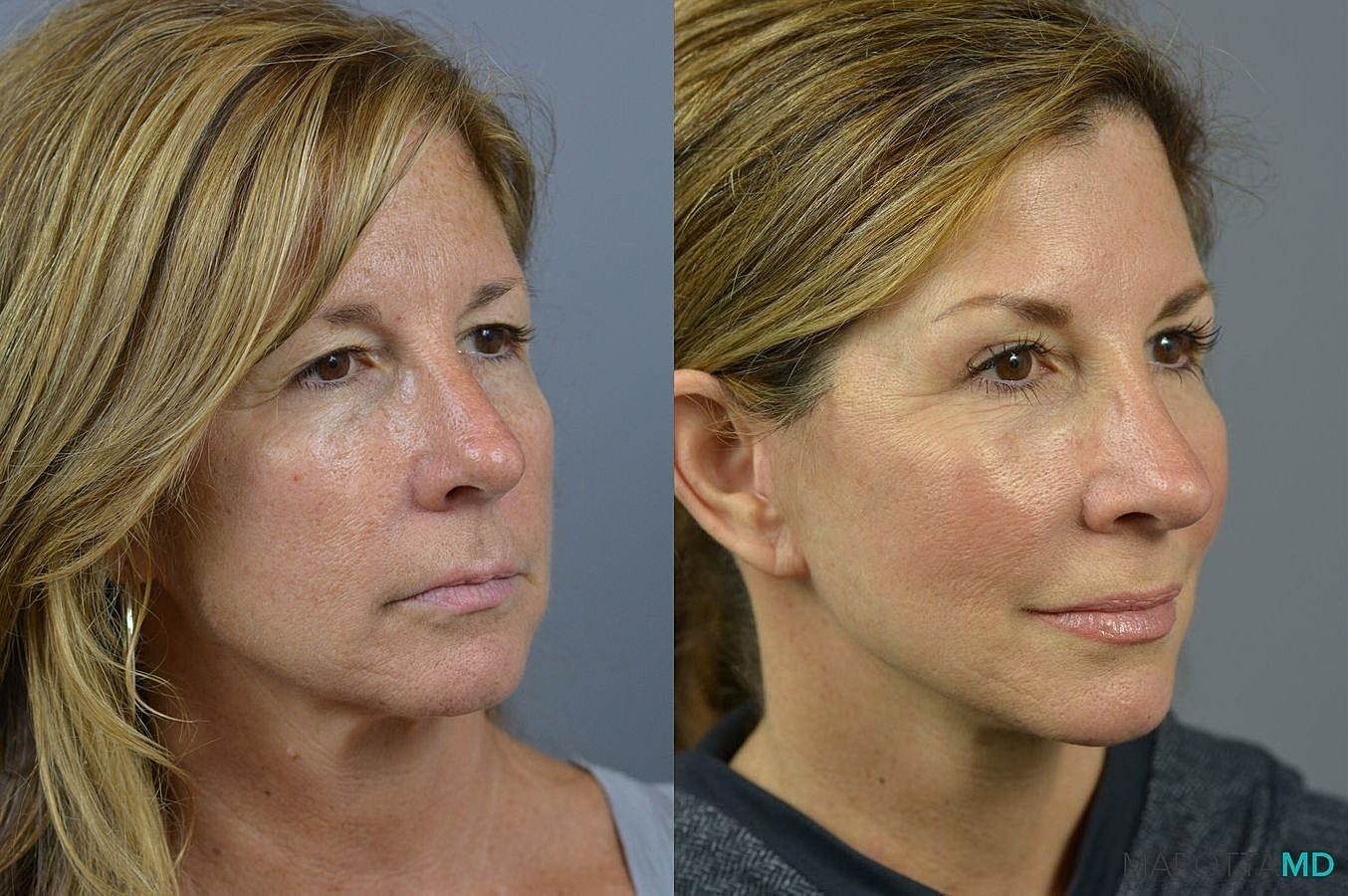 Eyelid Surgery Before & After