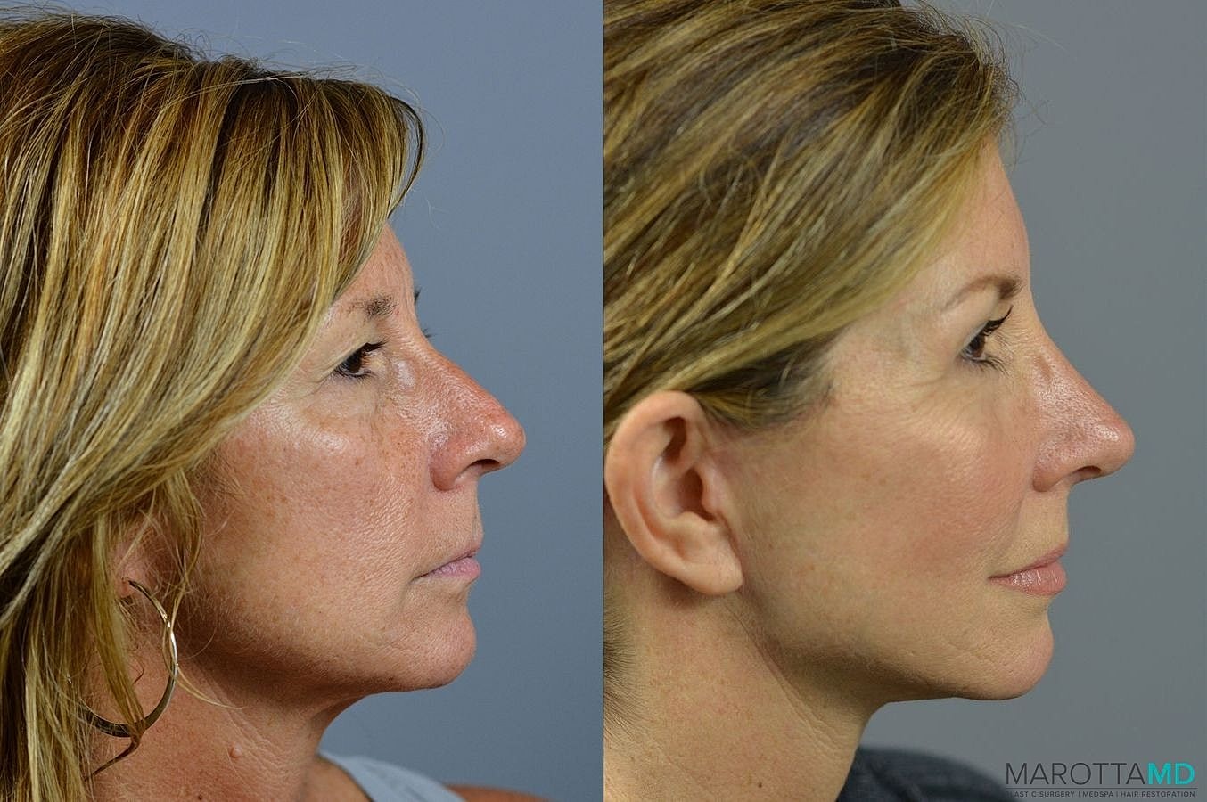 Eyelid Surgery Before & After