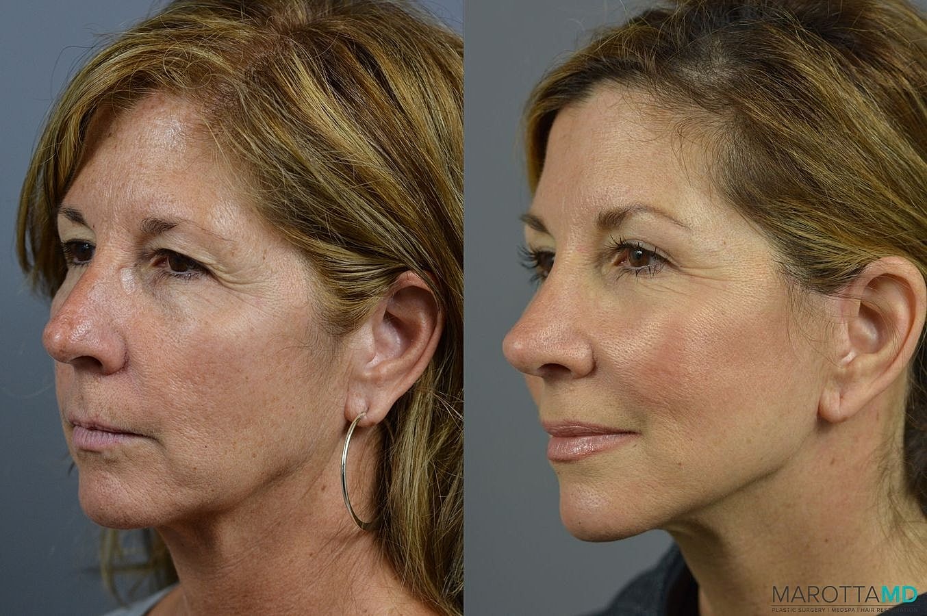 Eyelid Surgery Before & After