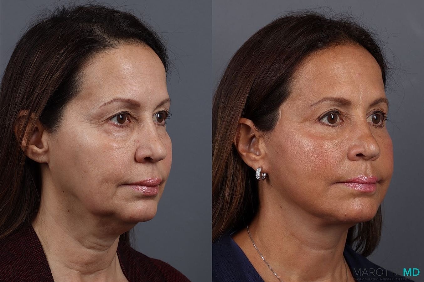 Eyelid Surgery Before & After