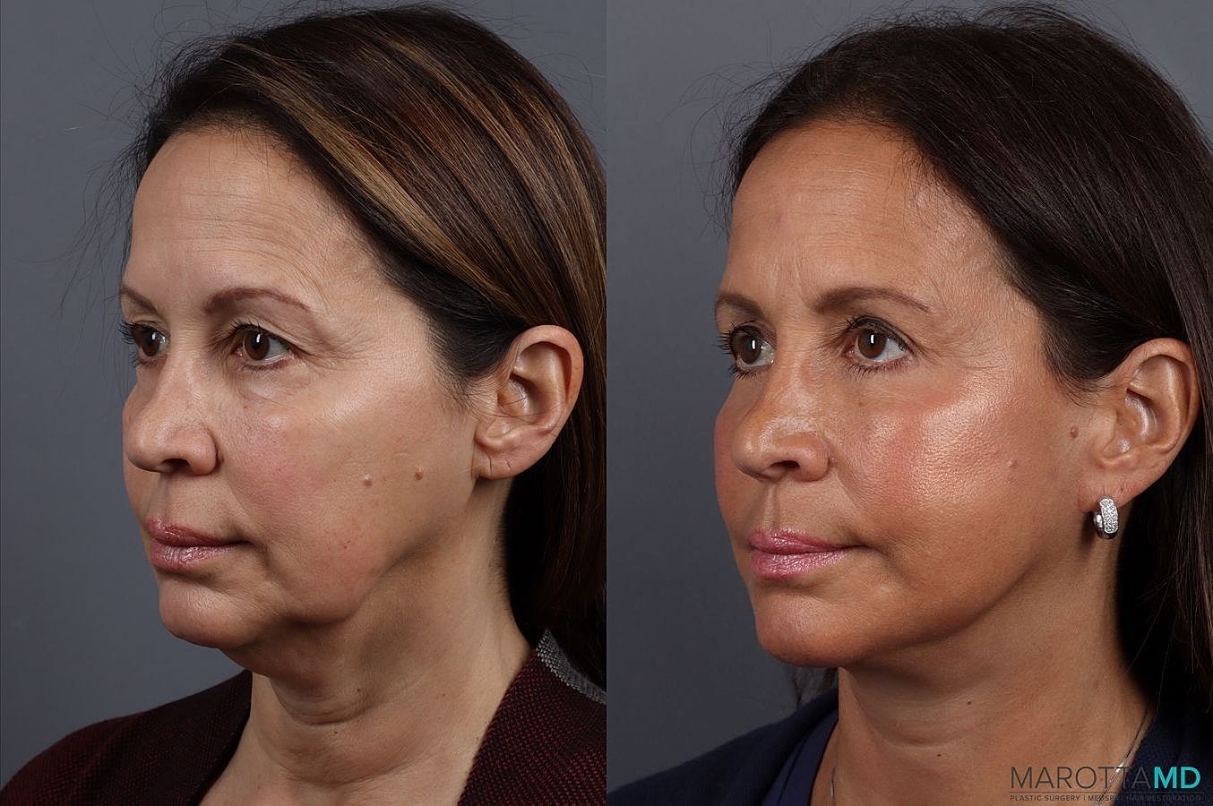 Eyelid Surgery Before & After