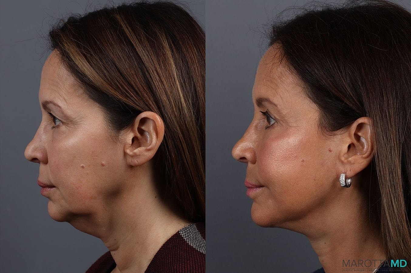 Eyelid Surgery Before & After