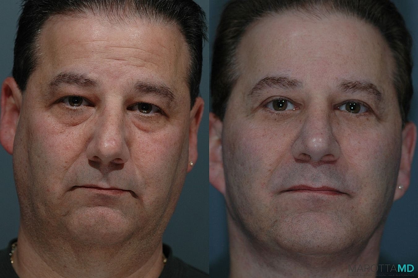 Eyelid Surgery Before & After