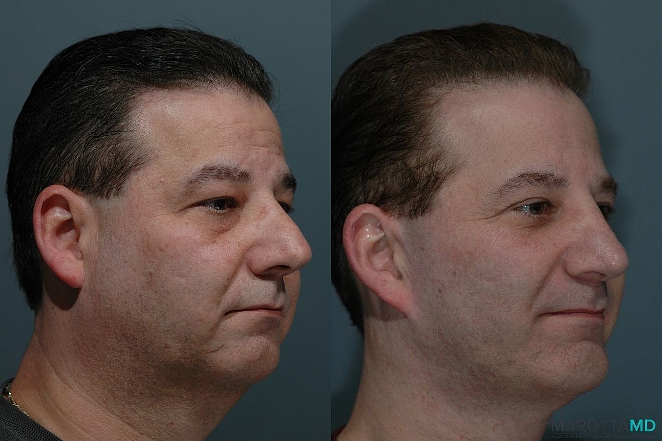 Eyelid Surgery Before & After