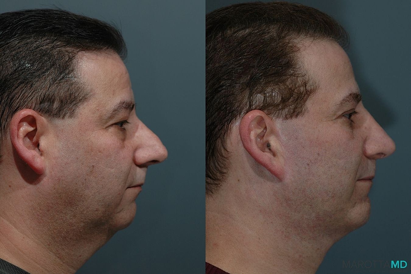 Eyelid Surgery Before & After