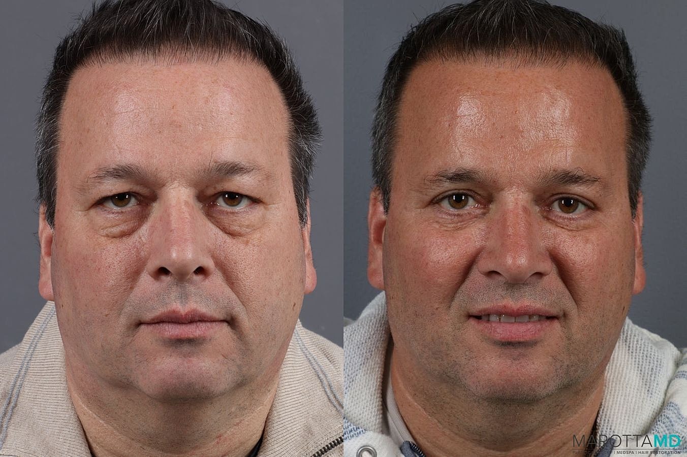 Eyelid Surgery Before & After