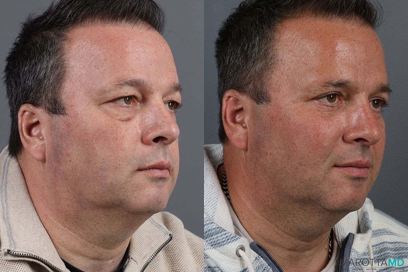 Eyelid Surgery Before & After