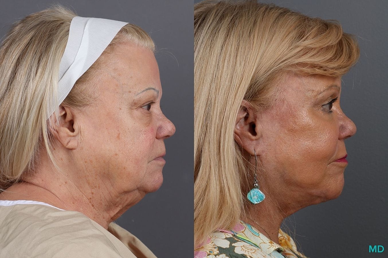 Eyelid Surgery Before & After