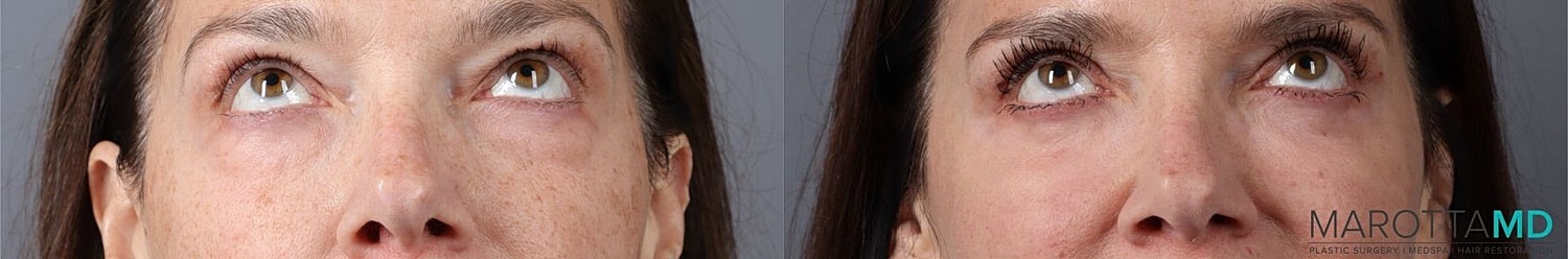 Eyelid Surgery Before & After