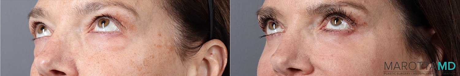 Eyelid Surgery Before & After