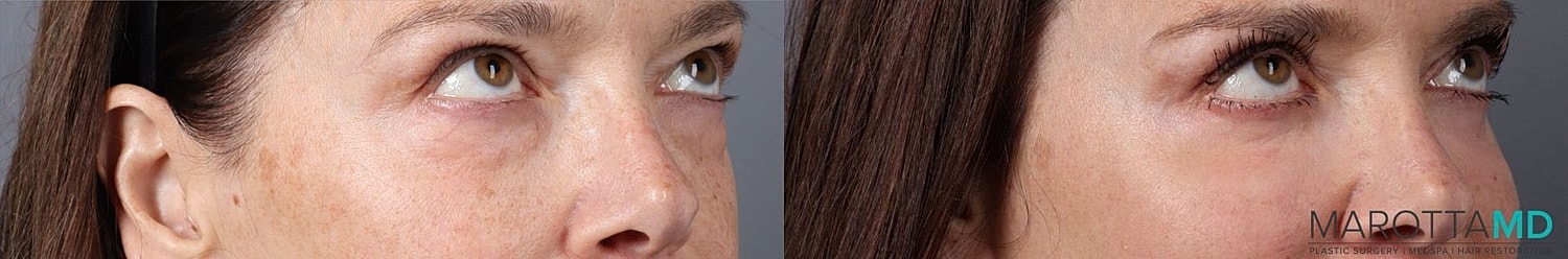 Eyelid Surgery Before & After